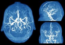 6 Scary Signs of a Brain Aneurysm Everyone Should Know