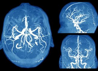 6 Scary Signs of a Brain Aneurysm Everyone Should Know